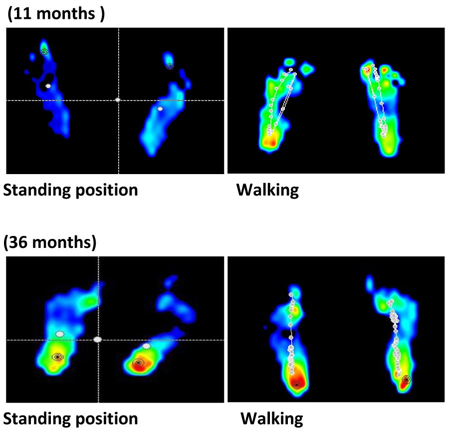 Plantar pressure assessment change depends on age and position