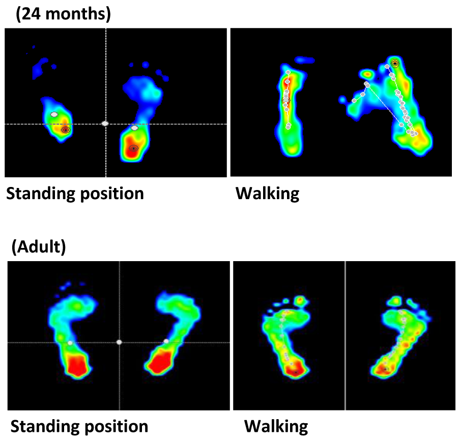 Plantar pressure assessment change depends on age and position